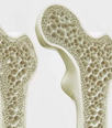 Advance Osteoporosis Profile Test, Low Dose Of X-ray, Dexa Scan, Bone Density Scan, Osteoporosis Blood Test, ALP or BALP, Osteocalcin