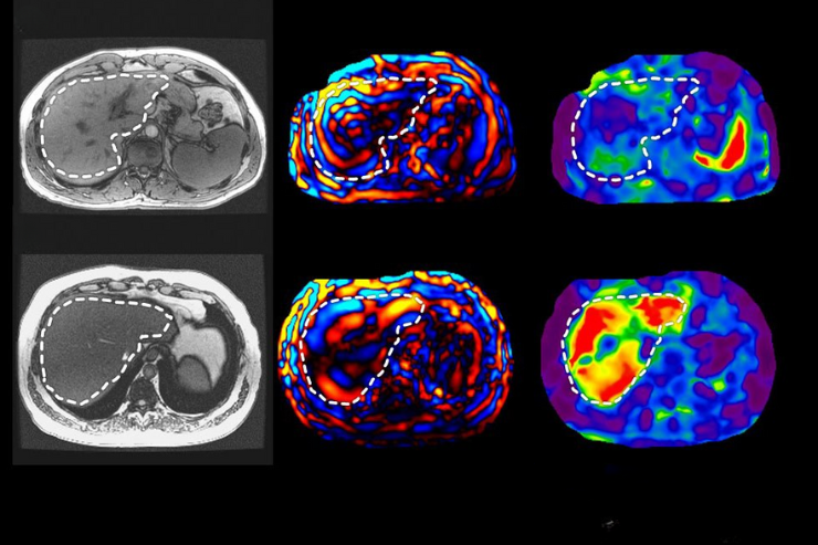 MR Elastography