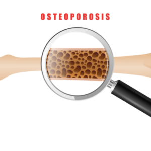 osteoporosis profile Basic