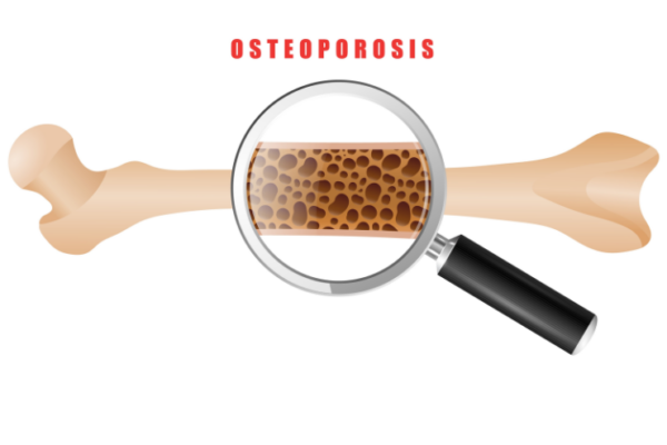 osteoporosis profile Basic