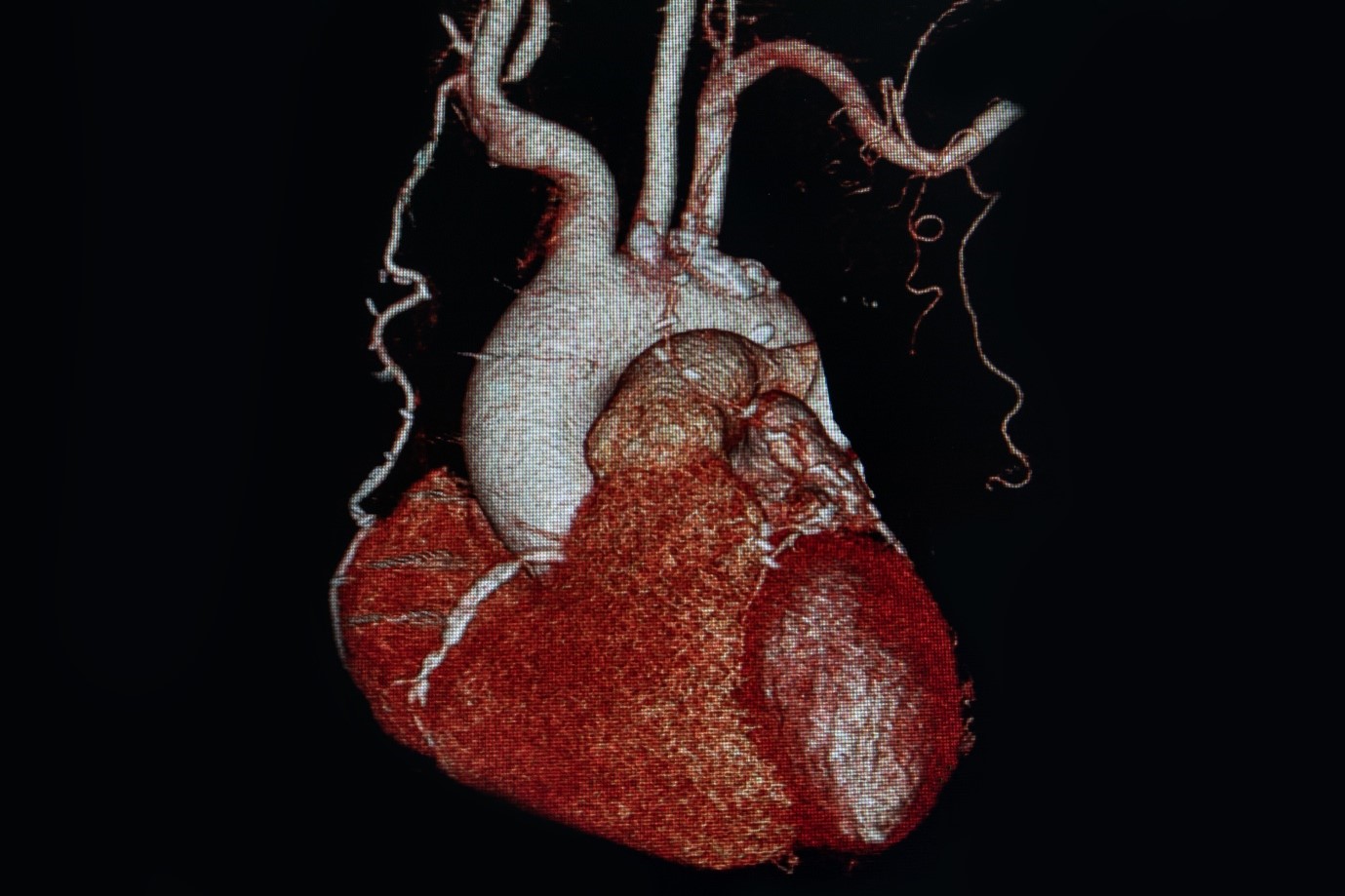 What You Need to Know About CT Angiograms: A Comprehensive Guide