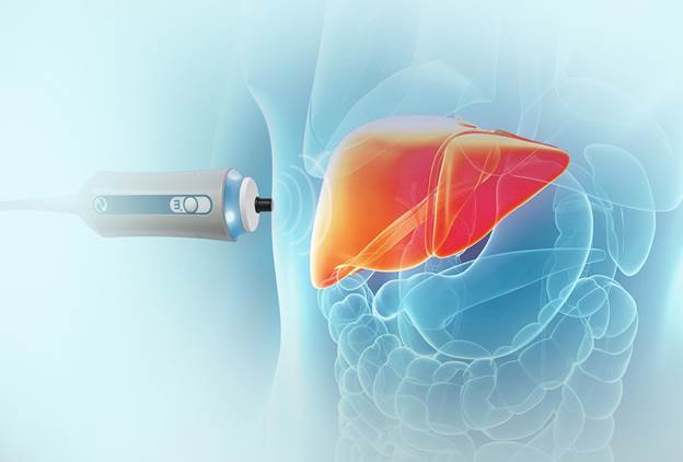 Understanding Elastography for Liver Health: A Comprehensive Guide